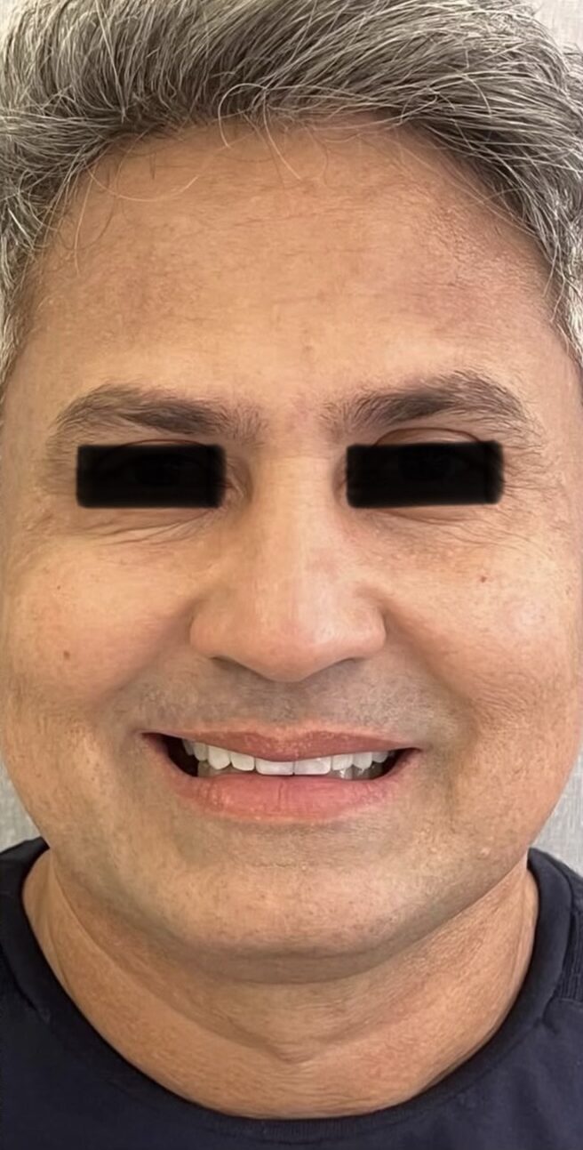Despues