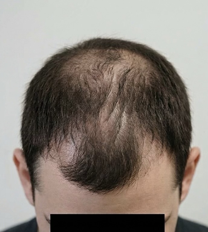 Antes